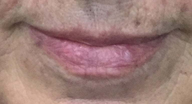 Picture of mouth before dermal fillers