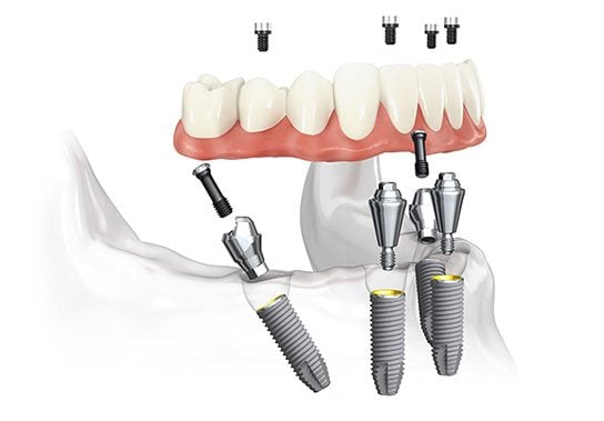 Illustration of how the all on 4 dental implant process works.