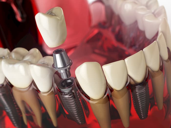 Image of what a dental implant looks like with abutment and dental crown.