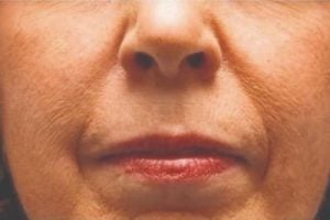 Picture of mouth before dermal fillers
