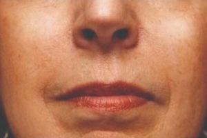 Picture of mouth after dermal fillers