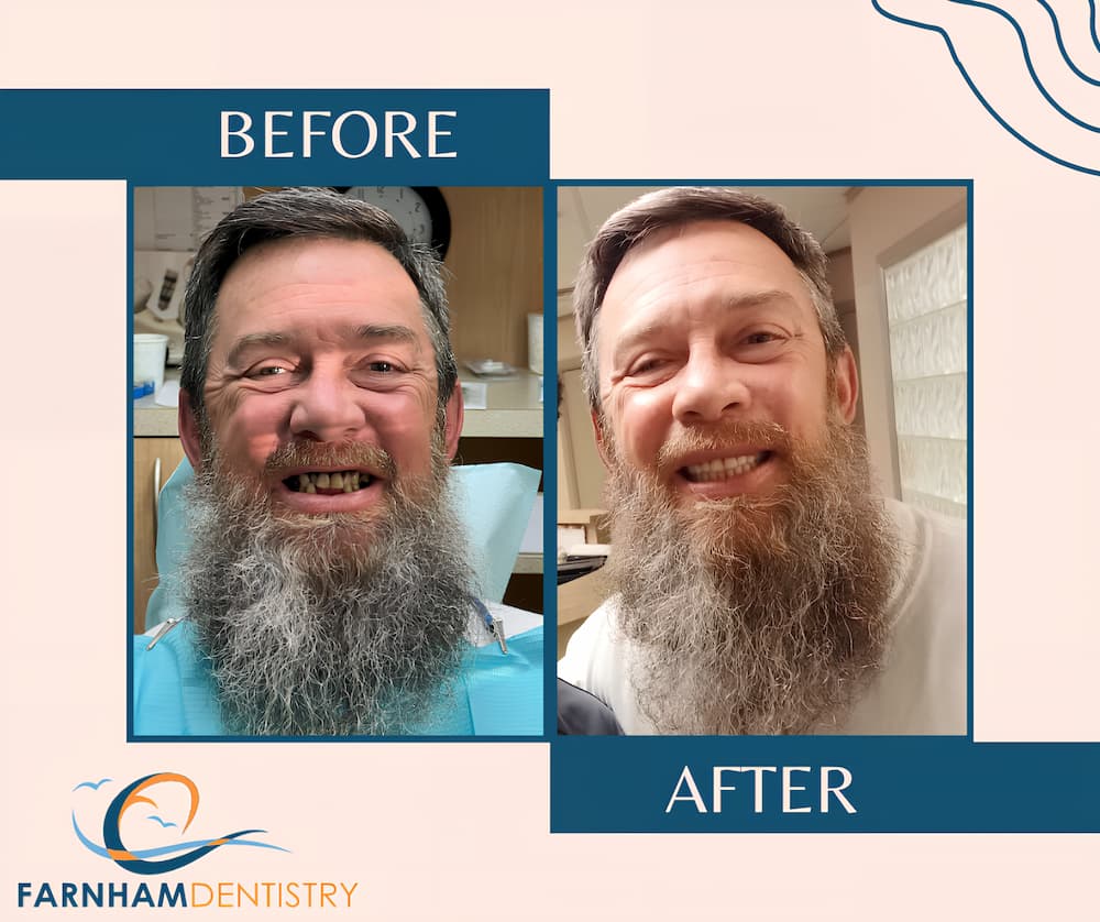 Before and after image of one of our patients who had his missing teeth replaced.