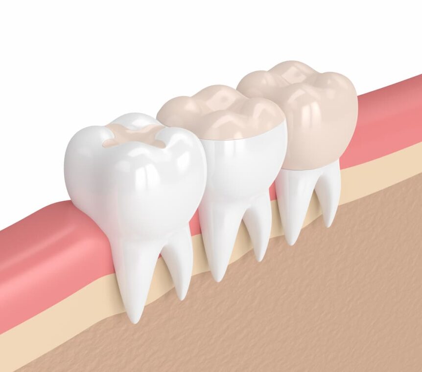 3D rendering example of inlays, onlays, and crowns, dental restorations.